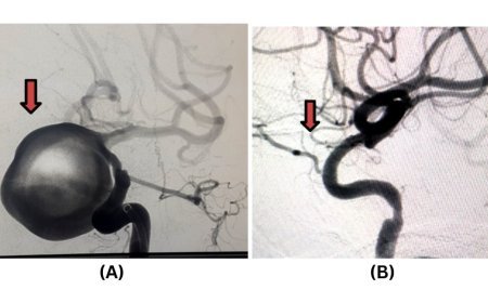 Pioneering Neurointerventional Excellence at Jehangir Hospital